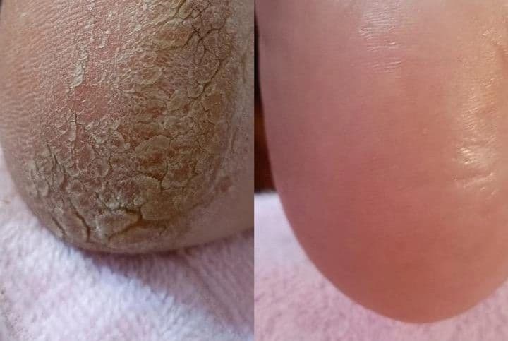 Lucinha Podologa, Recuperação, foto 1 de 3